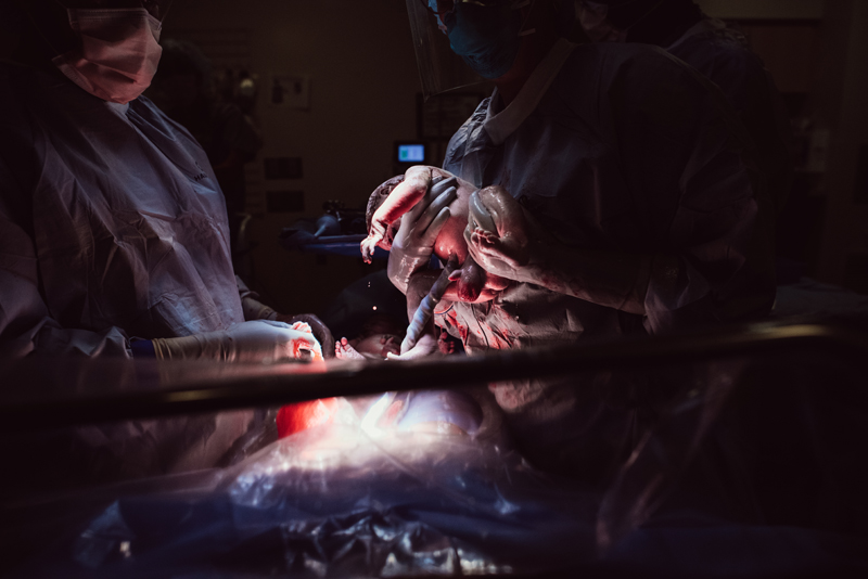 Birth Photography - Surgeons hold a newborn baby during a c-section. Baby is born.
